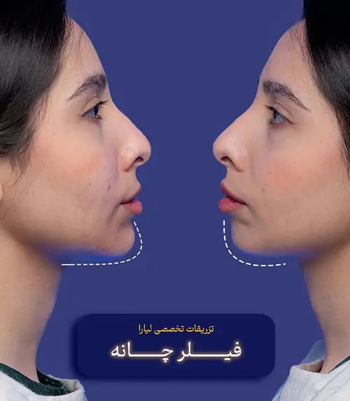 تزریق فیلر چانه کلینیک زیبایی لیارا کرج